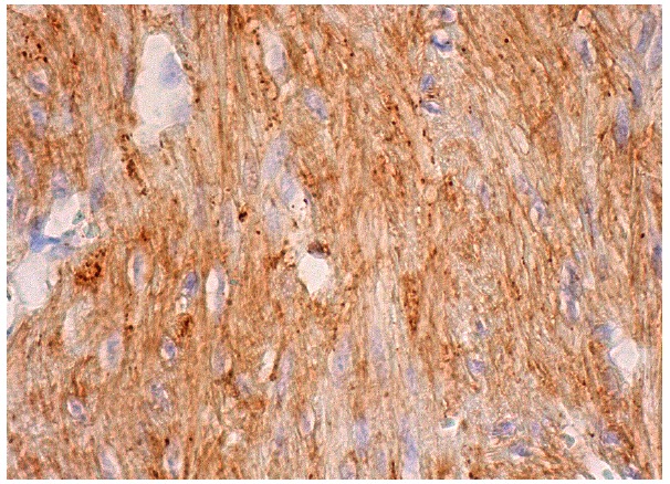 Mel-CAM (C-20): sc-18942. Immunoperoxidase staining of formalin fixed, paraffin-embedded human smooth muscle tissue showing cytoplasmic staining of smooth muscle cells.