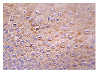 Mesothelin (C-2): sc-365324. Immunoperoxidase staining of formalin fixed, paraffin-embedded human cervix tissue showing cytoplasmic staining of squamous epithelial cells.