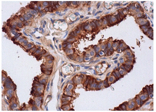 Mesothelin (H-280): sc-50426. Immunoperoxidase staining of formalin fixed, paraffin-embedded human fallopian tube tissue showing membrane and cytoplasmic staining of glandular cells.