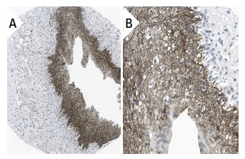 Nectin 1 (CK6): sc-21722. Immunoperoxidase staining of formalin fixed, paraffin-embedded human urinary bladder tissue showing membrane staining of urothelial cells (low and high magnification). Kindly provided by The Swedish Human Protein Atlas (HPA) program.