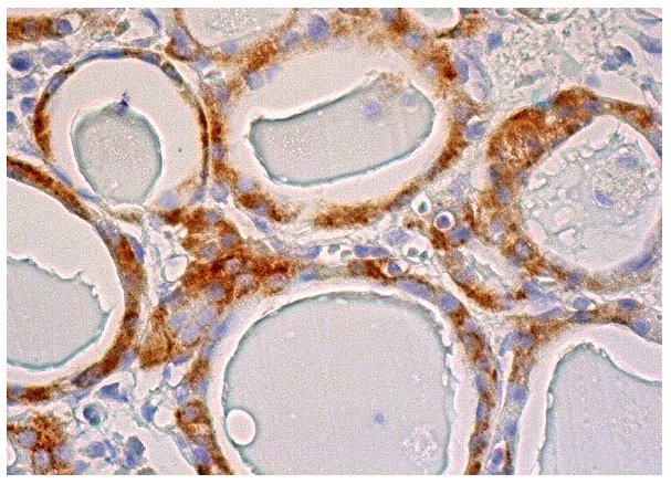 Nectin 3 (H-245): sc-28637. Immunoperoxidase staining of formalin fixed, paraffin-embedded human thyroid gland tissue showing cytoplasmic staining of glandular cells.