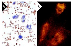 P-Selectin (M-20): sc-6943. Immunoperoxidase staining of formalin-fixed human platelets and white blood cells showing membrane staining of platelets (A). Rhodamine immunofluorescence staining of methanol-fixed HUV-EC-C cells showing membrane localization (B).