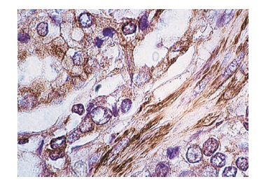Actin (C-2): sc-8432. Immunoperoxidase staining of formalin-fixed, paraffin-embedded human prostate carcinoma tissue showing cytoskeletal localization.