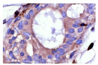 Arp3 (H-110): sc-15390. Immunoperoxidase staining of formalin-fixed, paraffin-embedded human breast tumor showing cytoplasmic staining.