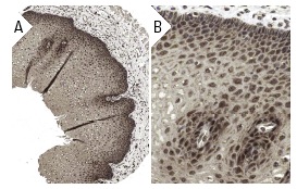 TC 21 (V-20): sc-883. Immunoperoxidase staining of formalin fixed, paraffin-embedded human esophagus tissue showing cytoplasmic and nuclear staining of surface epithelial cells at low (A) and high (B) magnification. Kindly provided by The Swedish Human Protein Atlas (HPA) program.