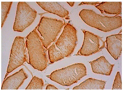 alpha;-sarcoglycan (F-7): sc-390647. Immunoperoxidase staining of formalin fixed, paraffin-embedded human skeletal muscle tissue showing membrane and cytoplasmic staining of myocytes.