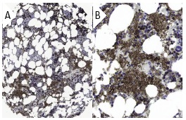 Ankyrin-1 (8C3): sc-12733. Immunoperoxidase staining of formalin fixed, paraffin-embedded human bone marrow tissue showing cytoplasmic and membrane staining of bone marrow poietic cells at low (A) and high (B) magnification. Kindly provided by The Swedish Human Protein Atlas (HPA) program.