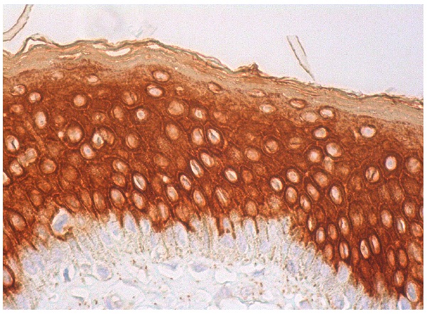 pan-Cytokeratin (D-12): sc-17843. Immunoperoxidase staining of formalin fixed, paraffin-embedded human vulva/anal skin tissue showing cytoplasmic staining of epidermal cells.