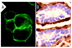 Filamin 1 (E-3): sc-17749. Immunofluorescence staining of methanol-fixed HeLa cells showing peripheral cytoplasmic localization (A). Immunoperoxidase staining of formalin fixed, paraffin-embedded human breast tumor showing cytoplasmic localization (B).