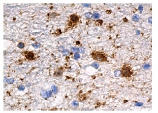 MAP-2 (A-4): sc-74421. Immunoperoxidase staining of formalin fixed, paraffin-embedded human brain tissue showing cytoplasmic and nuclear staining of neuronal cells.