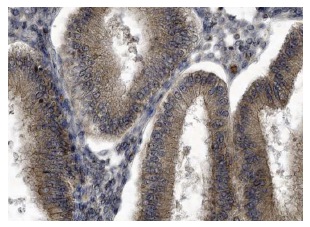Matrilin-2 (H-65): sc-66959. Immunoperoxidase staining of formalin fixed, paraffin-embedded human uterus tissue showing cytoplasmic staining of glandular cells at high magnification. Kindly provided by The Swedish Human Protein Atlas (HPA) program.