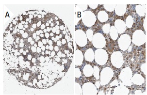 Tβ-4 (FL-44): sc-67114. Immunoperoxidase staining of formalin fixed, paraffin-embedded human bone marrow tissue showing cytoplasmic staining of bone marrow poietic cells in low (A) and high (B) resolution. Kindly provided by The Swedish Human Protein Atlas (HPA) program.