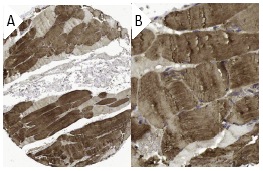 Troponin T-SS (H-55): sc-28269. Immunoperoxidase staining of formalin fixed, paraffin-embedded human skeletal muscle tissue showing cytoplasmic staining of myocytes at low (A) and high (B) magnification. Kindly provided by The Swedish Human Protein Atlas (HPA) program.