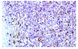 Vimentin (RV202): sc-32322. Immunoperoxidase staining of a tonsilar lymphoma. Kindly provided by MUBio, Netherlands.