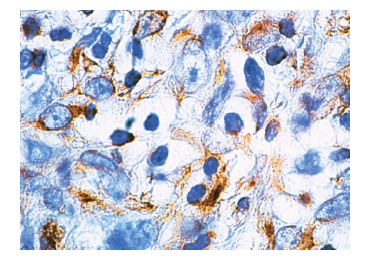 Vimentin (V9): sc-6260. Immunoperoxidase staining of formalin-fixed, paraffin-embedded human breast carcinoma tissue showing cytoskeletal localization.