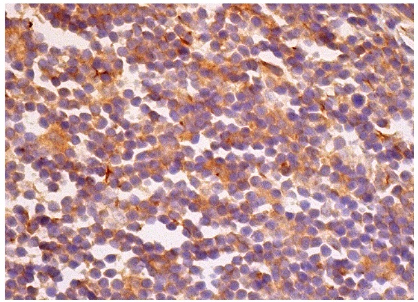 WIP (G-20): sc-16882. Immunoperoxidase staining of formalin fixed, paraffin-embedded human appendix tissue showing cytoplasmic staining of lymphoid cells.