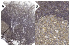 WIP (H-224): sc-25533. Immunoperoxidase staining of formalin fixed, paraffin-embedded human tonsil tissue showing cytoplasmic staining of follicle and non-follicle cells at low (A) and high (B) magnification. Kindly provided by The Swedish Human Protein Atlas (HPA) program.