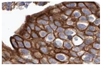 C21orf62 (T-14): sc-83562. Immunoperoxidase staining of formalin fixed, paraffin-embedded human Urinary bladder showing membrane staining of urothelial cells at high magnification. Kindly provided by The Swedish Human Protein Atlas (HPA) program.
