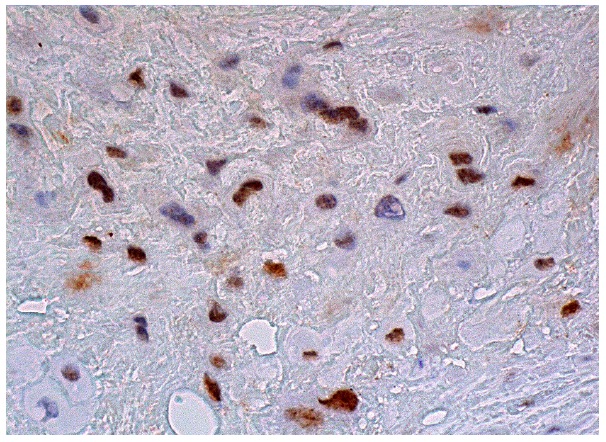 MBD2 (C-11): sc514062. Immunoperoxidase staining of formalin fixed, paraffin-embedded human placenta tissue showing nuclear staining of decidual cells.