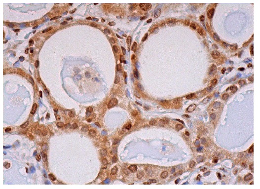 Presenilin 1 (N-19): sc-1245. Immunoperoxidase staining of formalin fixed, paraffin-embedded human thyroid gland tissue showing cytoplasmic and nuclear staining of glandular cells.