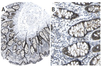 SMN (2B1): sc-32313. Immunoperoxidase staining of formalin fixed, paraffin-embedded human colon tissue showing cytoplasmic staining in glandular cells (low and high magnification). Kindly provided by The Swedish Human Protein Atlas (HPA) program.