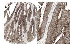 ZO-2 (H-110): sc-11448. Immunoperoxidase staining of formalin fixed, paraffin-embedded human colo-rectal cancer tissue showing membrane and cytoplasmic staining of tumor cells at low (A) and high (B) magnification. Kindly provided by The Swedish Human Protein Atlas (HPA) program.