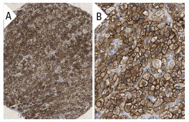 KCNQ1 (H-130): sc-20816. Immunoperoxidase staining of formalin fixed, paraffin-embedded human adrenal gland tissue showing membrane staining of cortical cells (low and high magnification). Kindly provided by The Swedish Human Protein Atlas (HPA) program.