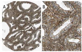 PMCA1/4 (5F10): sc-20028. Immunoperoxidase staining of formalin fixed, paraffin-embedded human uterine corpus tissue showing membrane staining of cells in endometrial stroma and glandular cells (low and high magnification). Kindly provided by The Swedish Human Protein Atlas (HPA) program.
