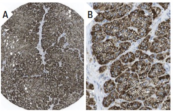 BACE (61-3E7): sc-33711. Immunoperoxidase staining of formalin fixed, paraffin-embedded human adrenal gland tissue showing cytoplasmic staining of cortical cells (low and high magnification). Kindly provided by The Swedish Human Protein Atlas (HPA) program.