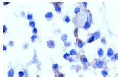 β-2-Microglobulin (BBM.1): sc-13565. Immunoperoxidase staining of formalin-fixed, paraffin-embedded bone marrow tissue showing membrane staining.