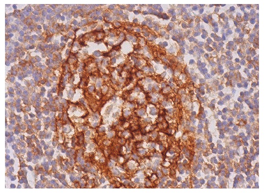 CD23 (C-19): sc-7021. Immunoperoxidase staining of formalin fixed, paraffin-embedded human lymph node tissue showing membrane and cytoplasmic staining of cells in germinal centers and cells in non-germinal centers.