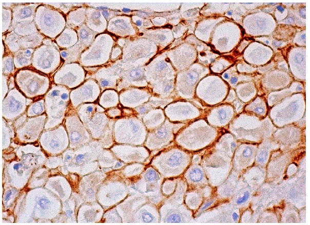 CD55 (NaM16-4D3): sc-51733. Immunoperoxidase staining of formalin fixed, paraffin-embedded human placenta tissue showing membrane staining of decidual cells.