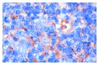 CD63 (MX-49.129.5): sc-5275. Immunoperoxidase staining of formalin-fixed, paraffin-embedded human lymphoma showing cytoplasmic staining.
