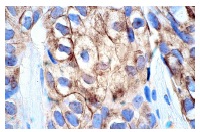 CD71 (DF1513): sc-7327. Immunoperoxidase staining of formalin-fixed, paraffin-embedded human breast carcinoma tissue showing membrane staining.