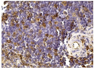 CD74 (LN-2): sc-6262. Immunoperoxidase staining of formalin fixed, paraffin-embedded human spleen tissue showing membrane staining of cells in white pulp.