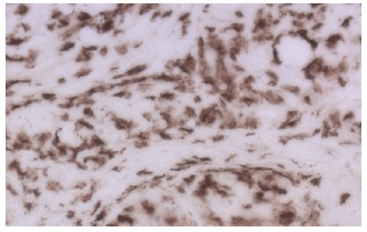 CD8-α (53-6.7): sc-18913. Immunoperoxidase staining of paraformaldehyde-fixed, frozen tissue sections. Infiltrating CD8+ T cells in allogeneic skin engrafted onto mouse. Kindly provided by The M.C. Zúñiga Lab, University of California Santa Cruz.