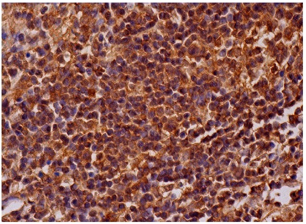 Chitotriosidase (C-18): sc-46855. Immunoperoxidase staining of formalin fixed, paraffin-embedded human lymph node tissue showing cytoplasmic staining of cells in germinal centers and cells in non-germinal centers.