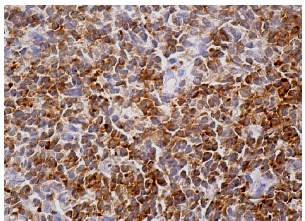 CIN85 (A-7): sc-166862. Immunoperoxidase staining of formalin fixed, paraffin-embedded human lymph node tissue showing cytoplasmic staining of cells in germinal and non-germinal centers.