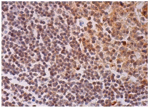 CIN85 (S-19): sc-22883. Immunoperoxidase staining of formalin fixed, paraffin-embedded human lymph node tissue showing nuclear and cytoplasmic staining of cells in germinal center and nuclear staining of cells in non-germinal center.