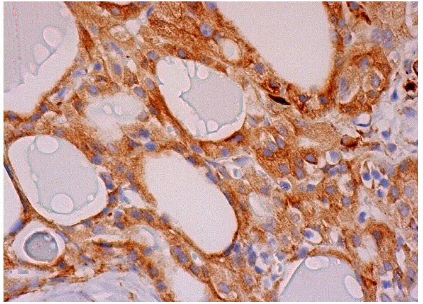 ERp46 (F-3): sc-271465. Immunoperoxidase staining of formalin fixed, paraffin-embedded human thyroid gland tissue showing cytoplasmic staining of glandular cells.