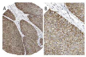Glycophorin A (H-60): sc-20628. Immunoperoxidase staining of formalin fixed, paraffin-embedded human urothelial cancer showing membrane staining of tumor cells (low and high magni?fication). Kindly provided by The Swedish Human Protein Atlas (HPA) program.