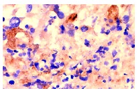 LAMP-2 (H4B4): sc-18822. Immunoperoxidase staining of formalin fixed, paraffin-embedded human kidney tumor showing membrane and cytoplasmic localization.