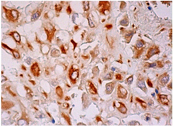 MASP-2 (N-20): sc-17905. Immunoperoxidase staining of formalin fixed, paraffin-embedded human placenta tissue showing cytoplasmic staining of decidual cells.