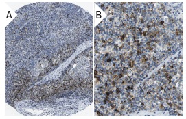 Ox40 (BER-Act35): sc-20073. Immunoperoxidase staining of formalin fixed, paraffin-embedded human lymph node tissue showing membrane and cytoplasmic staining of non-follicle cells (low and high magnification). Kindly provided by The Swedish Human Protein Atlas (HPA) program.