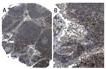 DAT (6-8D6): sc-32259. Immunoperoxidase staining of formalin fixed, paraffin-embedded human lymph node tissue showing cytoplasmic staining of lymphoid cells (low and high magnification). Kindly provided by The Swedish Human Protein Atlas (HPA) program.