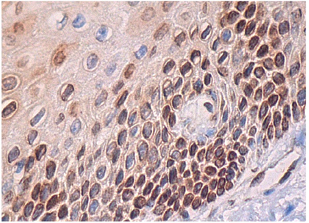ULBP4 (6E6): sc-53133. Immunoperoxidase staining of formalin fixed, paraffin-embedded human cervix tissue showing nuclear and cytoplasmic staining of squamous epithelial cells.