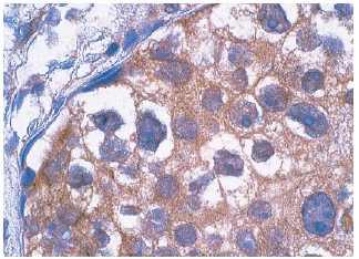 γ-catenin (H-1): sc-8415. Immunoperoxidase staining of formalin-fixed, paraffin-embedded human breast carcinoma showing membrane localization