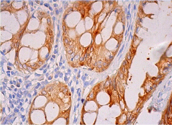 CEACAM5 (CI-P83-1): sc-23928. Immunoperoxidase staining of formalin fixed, paraffin-embedded human rectum tissue showing membrane and cytoplasmic staining of glandular cells.