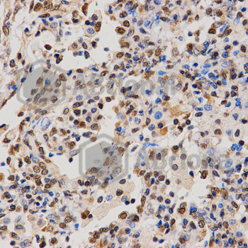 Immunohistochemistry of paraffin-embedded human lung cancer tissue using H4R3me2a antibody at dilution of 1:200 (x40 lens)
