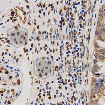 Immunohistochemistry of paraffin-embedded human rectal cancer tissue using H4R3me2a antibody at dilution of 1:200 (x40 lens)